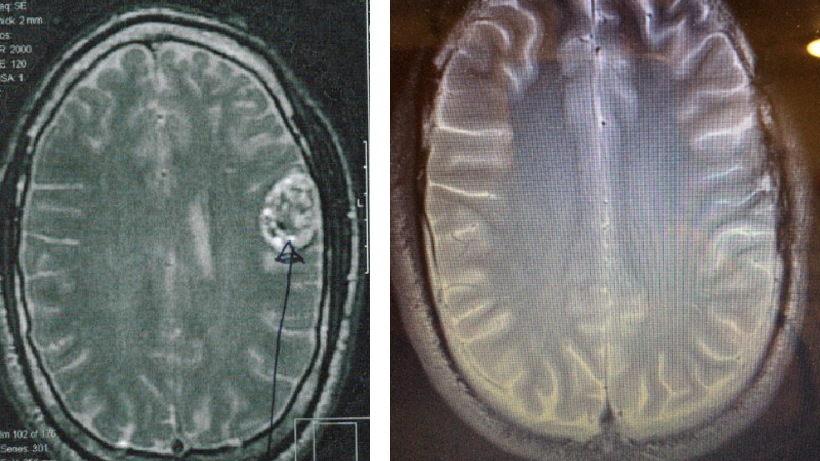 Ancestral Ketogenic Diets and Brain Cancer – The Scarborough Protocol