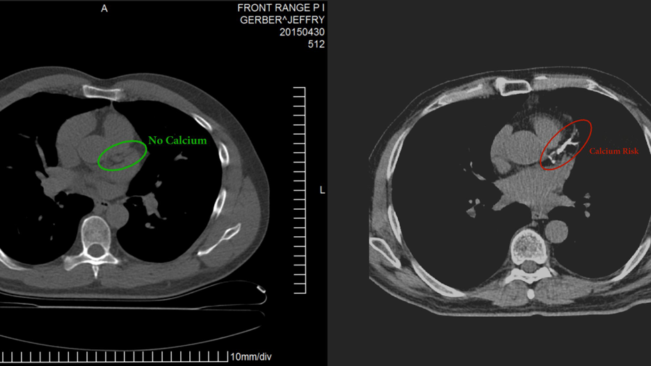 LCHF 15 years, Coronary Artery Calcium Score ZERO!